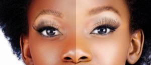 la-depigmentation-un-probleme-meconnue-par